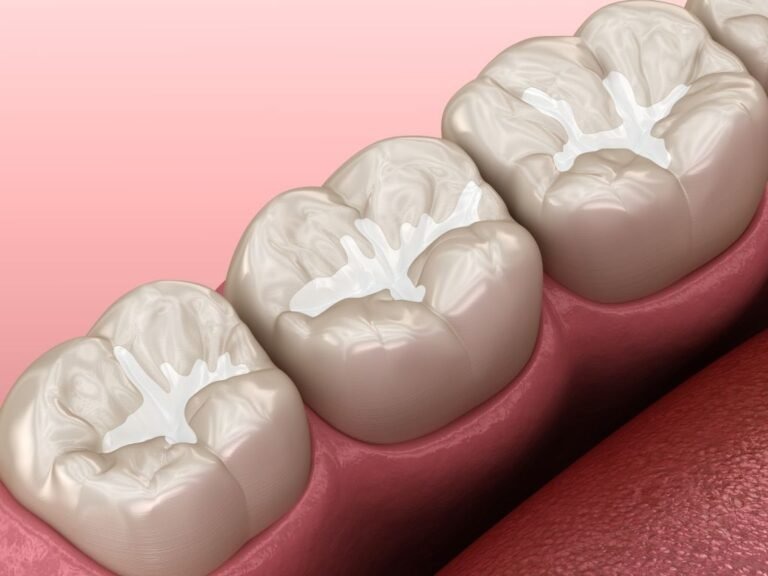 dental sealants for kids near you