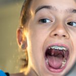 should-kids-wear-mouth-guards-at-night-scaled