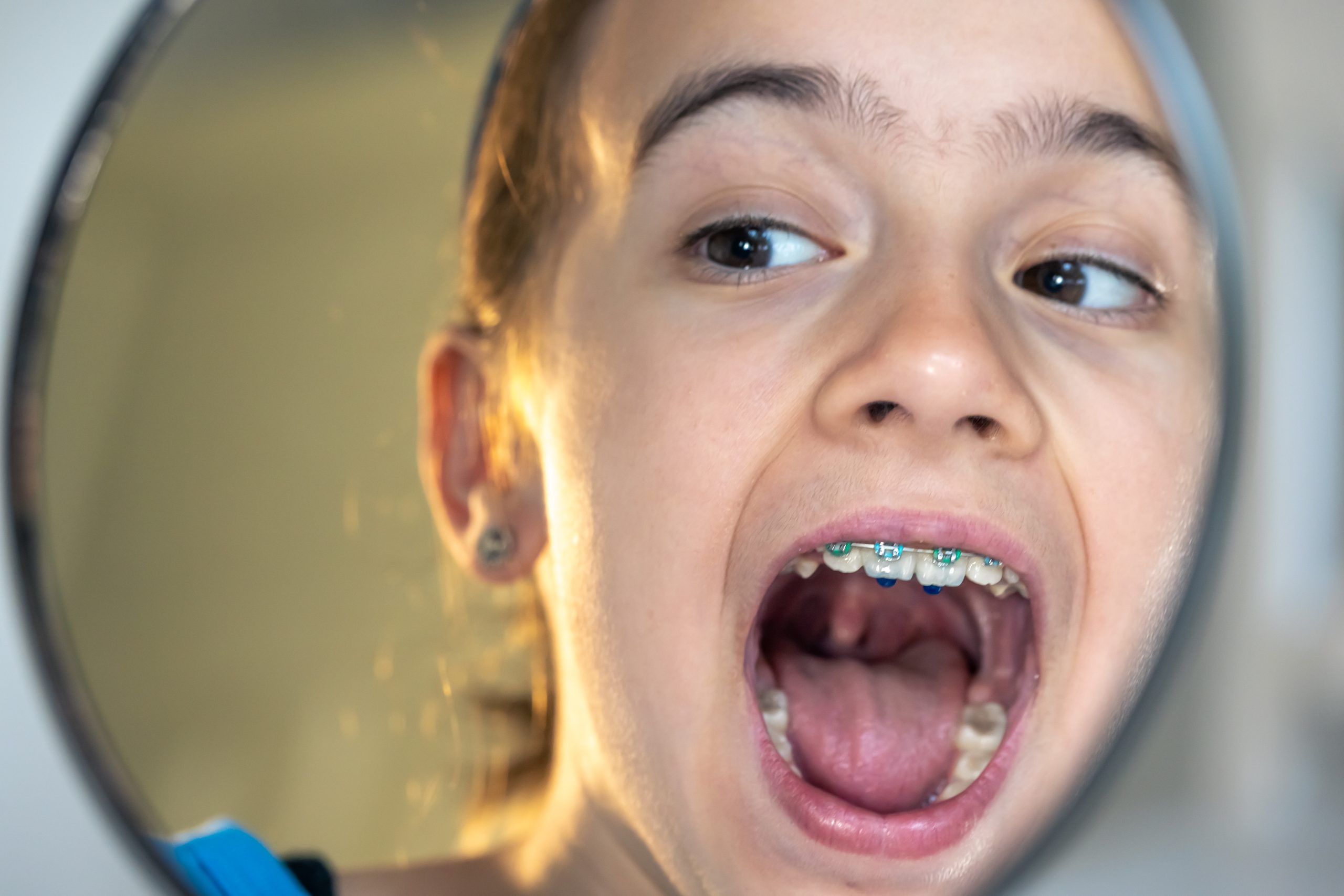 should-kids-wear-mouth-guards-at-night-scaled